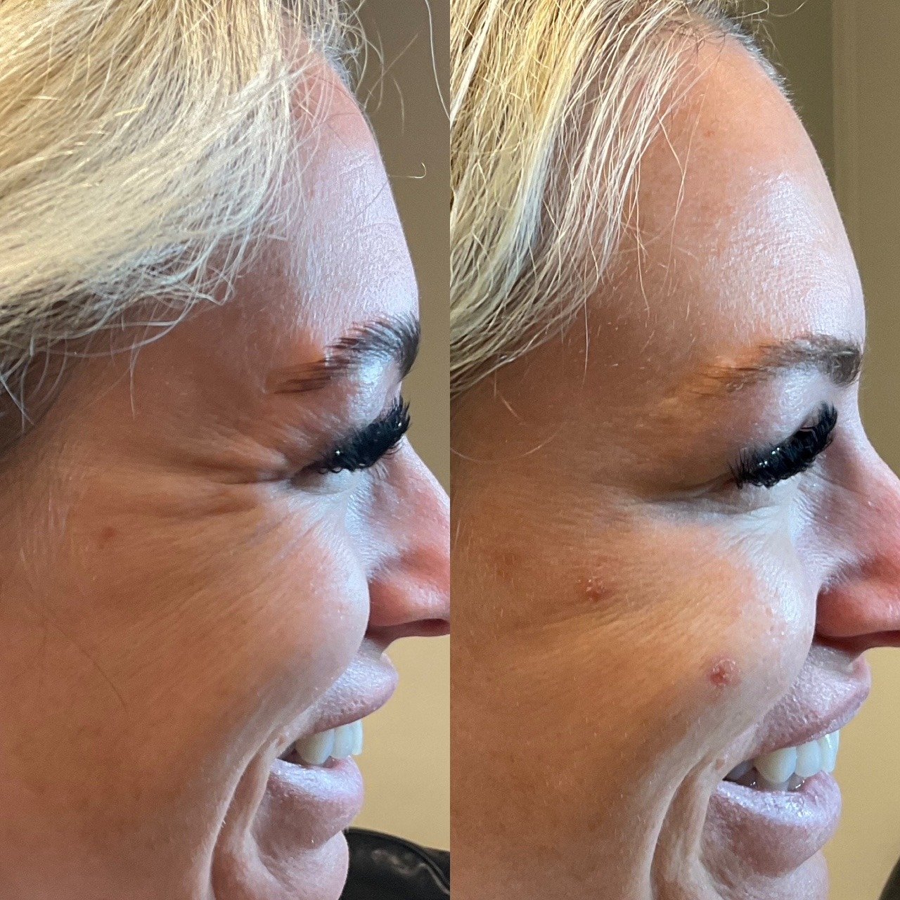 Wrinkle relaxer before and after result