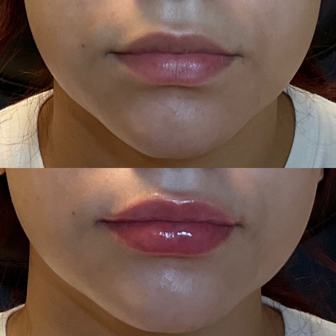 Lip filler before and after result