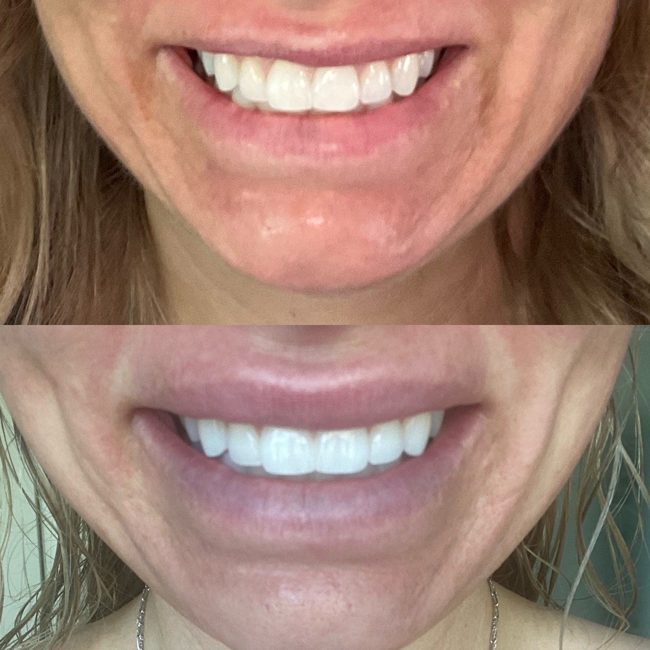 Dermal Filler Results